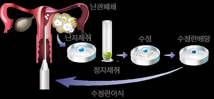 시험관 아기 시술 과정[사진 = 보건복지부]